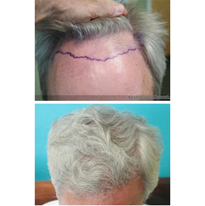 hair transplantation clinic peoria Scott Alexander, MD-Biltmore Surgical Hair Restoration