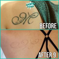tattoo removal service tucson Oops! Laser